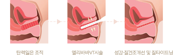 탄력잃은 조직 > 엘리바바VT시술 > 성감,질건조개선 및 질타이트닝