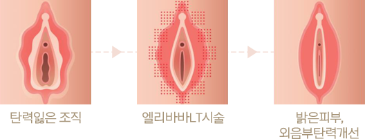 탄력잃은 조직 > 엘리바바LT시술 > 밝은피부, 외음부탄력개선